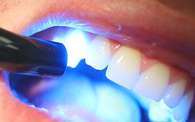 скільки коштує пломба