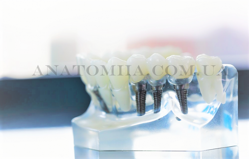 implantacziya zubiv