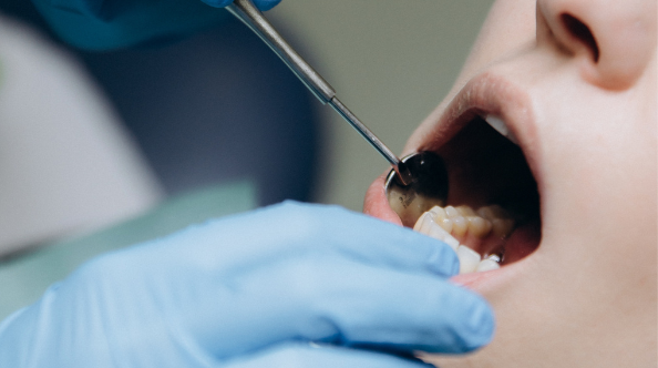 Зламані інструменти в кореневих каналах