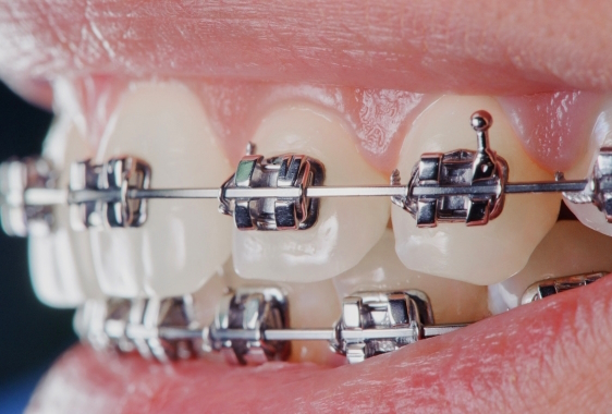 лікування безлігатурними брекетами