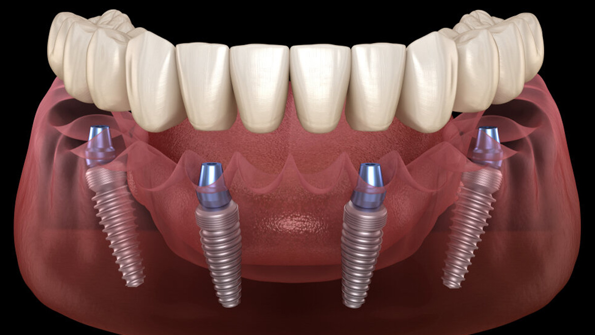 Імплантація All-on-4