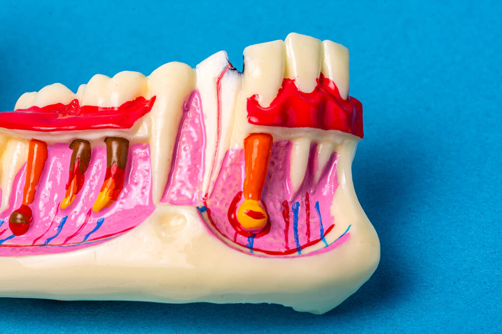 Dental educational model showing tooth decay and gum disease